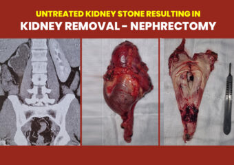Kidney Removal
