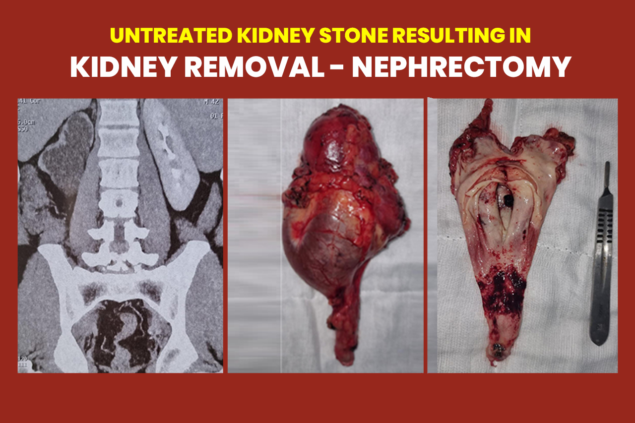 Kidney Removal-Nephrectomy