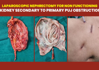 Laproscopic Nephrectomy for Non Functioning Kidney