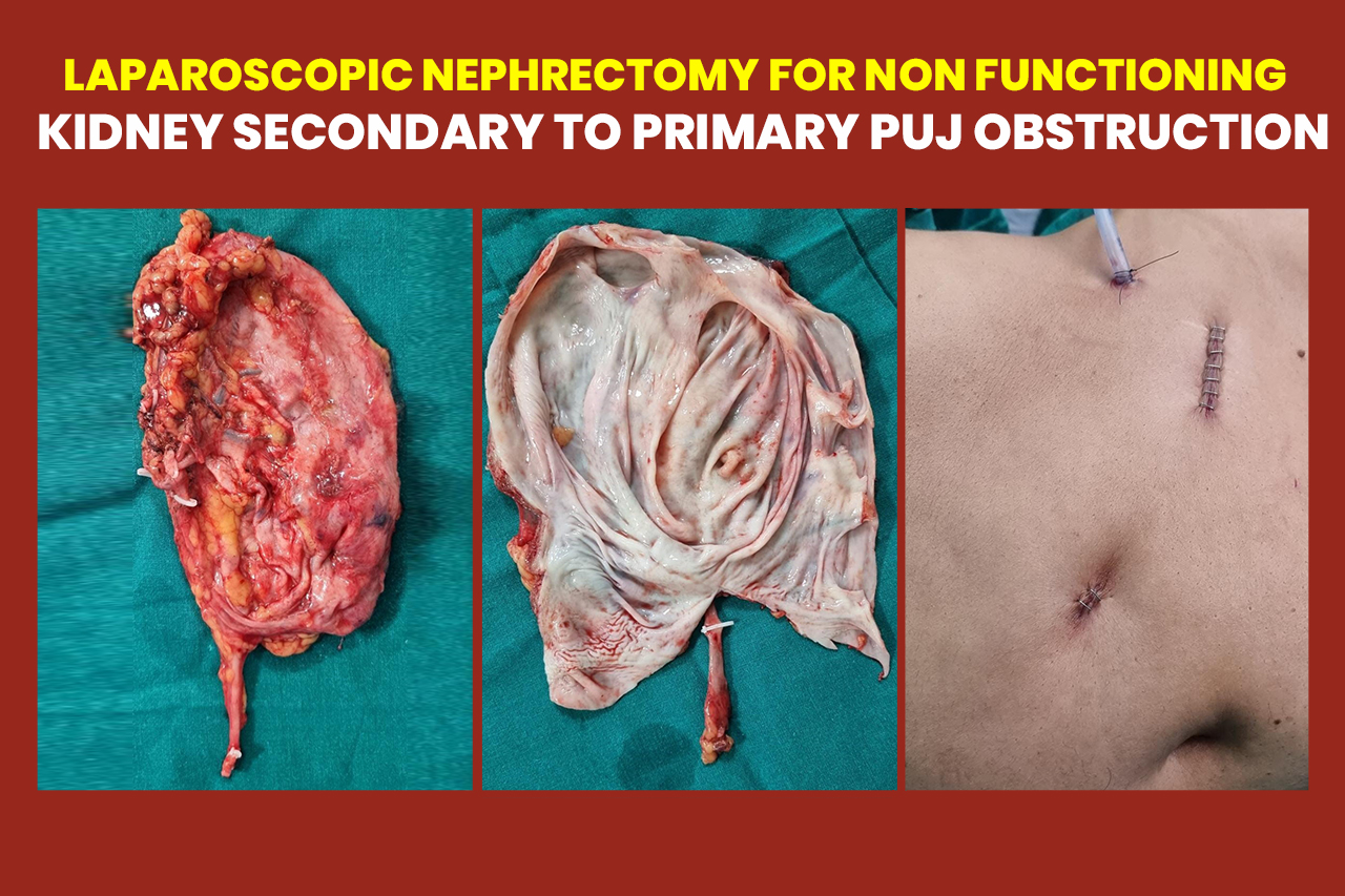 Laparoscopic nephrectomy for non functioning kidney secondary to primary puj obstruction