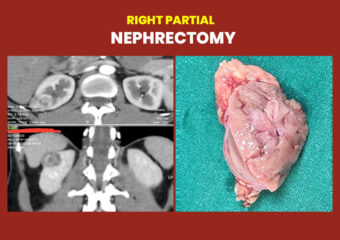Nepherectomy