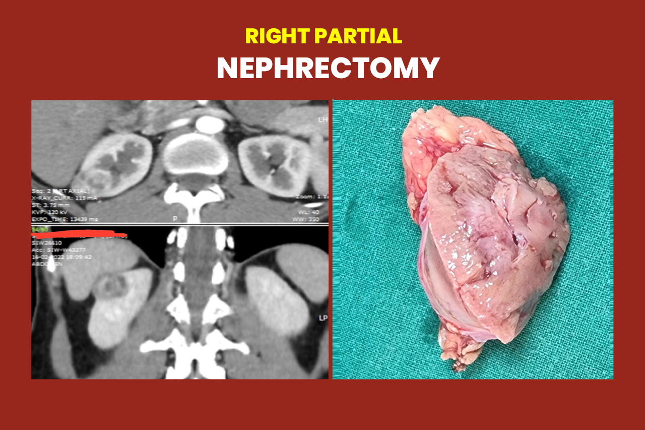 Right Partial Nephrectomy