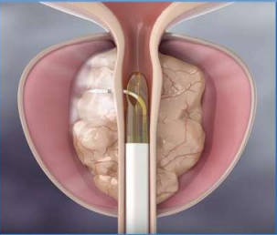Robotic Urology Image 1
